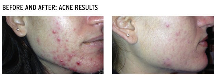 acne results